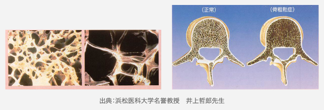 骨粗鬆症　写真